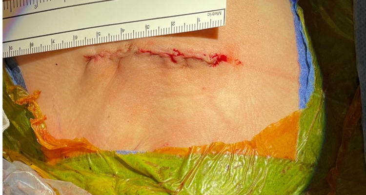 V UKC Ljubljana uvedli manj invazivne operacije prirojenih srčnih napak pri otrocih